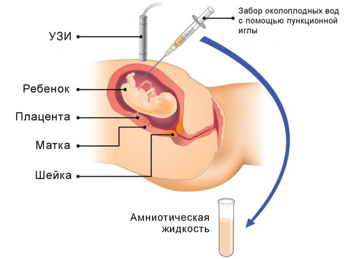 mukov scidoz u d tey novonarodzhenih scho ce za hvoroba oznaki simptomi prichini d agnostika ta l kuvannya z foto 18 - Муковісцидоз у дітей і новонароджених – що це за хвороба, ознаки, симптоми і причини, діагностика та лікування з фото