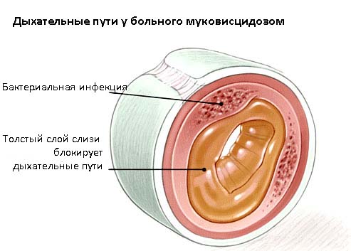 mukov scidoz u d tey novonarodzhenih scho ce za hvoroba oznaki simptomi prichini d agnostika ta l kuvannya z foto 6 - Муковісцидоз у дітей і новонароджених – що це за хвороба, ознаки, симптоми і причини, діагностика та лікування з фото