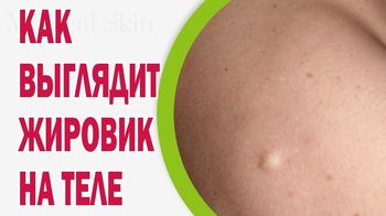 na golov z yavilisya shishki scho ce mozhe buti prichini l kuvannya 5 - На голові з’явилися шишки – що це може бути, причини, лікування