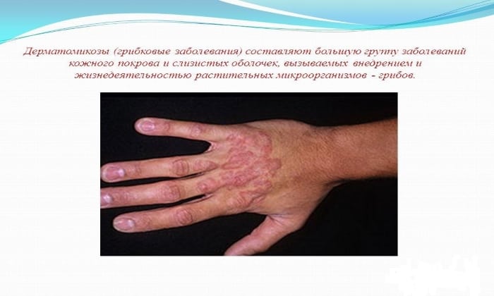 naftif n nstrukc ya z zastosuvannya c na v dguki analogi 2 - НАФТИФІН – Інструкція із застосування, ціна, відгуки і аналоги
