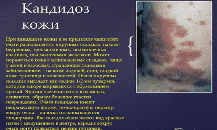 naftif n nstrukc ya z zastosuvannya c na v dguki analogi 4 - НАФТИФІН – Інструкція із застосування, ціна, відгуки і аналоги