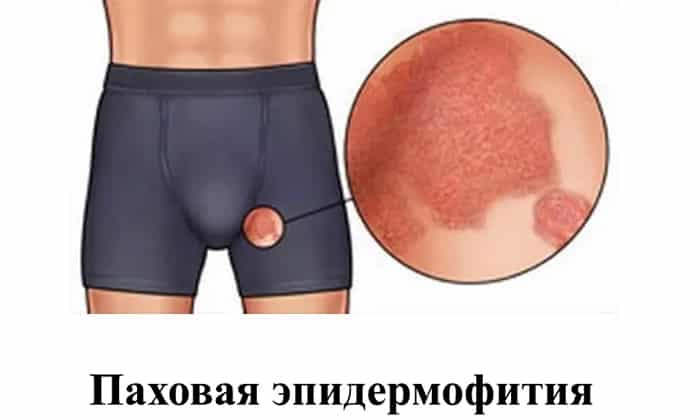 НИТРОФУНГИН ТЕВА – інструкція із застосування, ціна, відгуки і аналоги nitrofungin teva nstrukc ya z zastosuvannya c na v dguki analogi 1 - НИТРОФУНГИН ТЕВА – інструкція із застосування, ціна, відгуки і аналоги