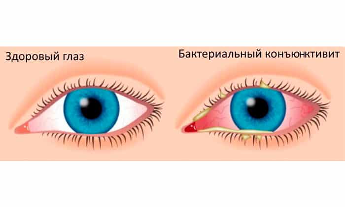 ОКОМІСТИН – Інструкція із застосування, ціна, відгуки і аналоги okom stin nstrukc ya z zastosuvannya c na v dguki analogi 3 - ОКОМІСТИН – Інструкція із застосування, ціна, відгуки і аналоги