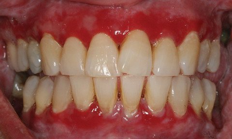 opuhla desna b lya zuba bolit nabryak p slya mplantac prichini l kuvannya 1 - Опухла десна біля зуба, болить, набряк після імплантації: причини, лікування