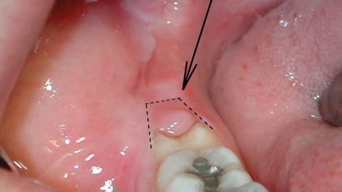 opuhla desna b lya zuba bolit nabryak p slya mplantac prichini l kuvannya 2 - Опухла десна біля зуба, болить, набряк після імплантації: причини, лікування