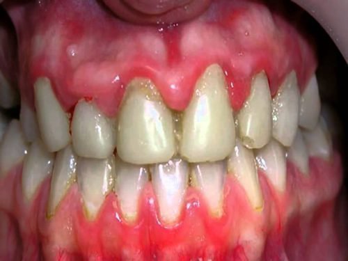 opuhla desna b lya zuba bolit nabryak p slya mplantac prichini l kuvannya 3 - Опухла десна біля зуба, болить, набряк після імплантації: причини, лікування