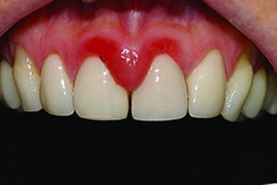 opuhla desna b lya zuba bolit nabryak p slya mplantac prichini l kuvannya 4 - Опухла десна біля зуба, болить, набряк після імплантації: причини, лікування