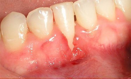 opuhla desna b lya zuba bolit nabryak p slya mplantac prichini l kuvannya 5 - Опухла десна біля зуба, болить, набряк після імплантації: причини, лікування