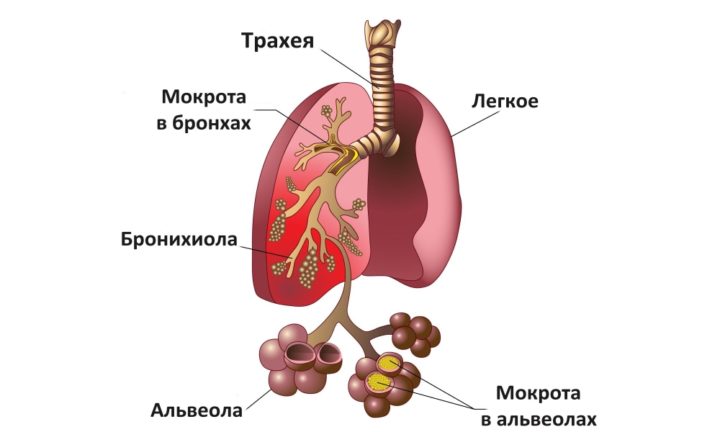 osnovn simptomi ta metodi d agnostiki pnevmon zapalennya legen v u d tey 2 - Основні симптоми та методи діагностики пневмонії (запалення легенів) у дітей