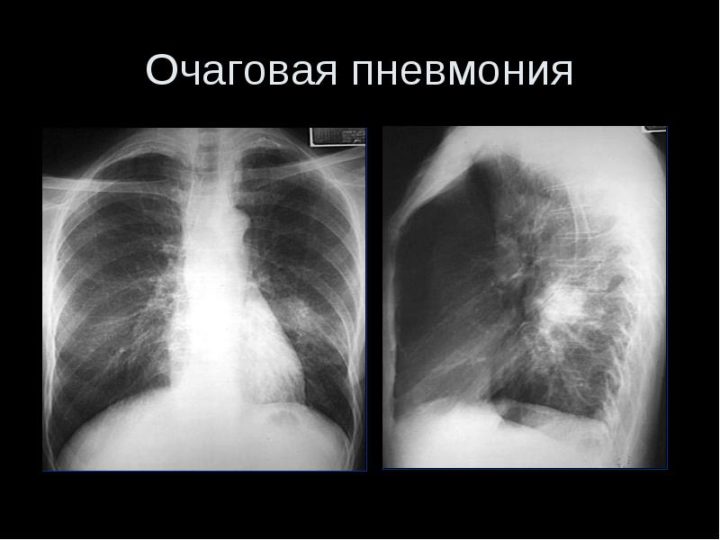 osnovn simptomi ta metodi d agnostiki pnevmon zapalennya legen v u d tey 4 - Основні симптоми та методи діагностики пневмонії (запалення легенів) у дітей
