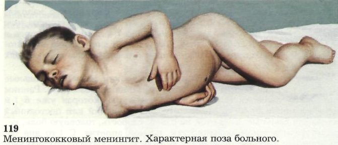 osoblivost pereb gu ta l kuvannya men ngokokovo nfekc u d tey 6 - Особливості перебігу та лікування менінгококової інфекції у дітей