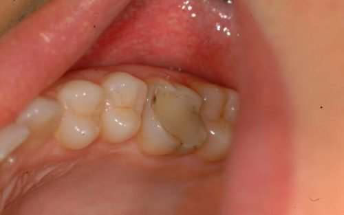 p slya plombuvannya bolit zub pri natiskann reagu na holodne 6 - Після пломбування болить зуб при натисканні, реагує на холодне