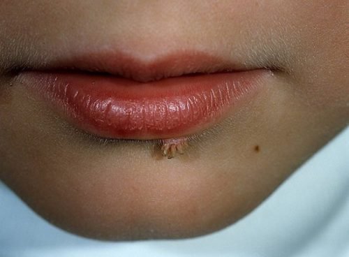 pap loma na gubah l kuvannya vidalennya h d operac 2 - Папілома на губах: лікування, видалення, хід операції