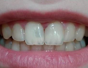 plombuvannya peredn h zub v yaku krasche staviti plombu mater al 5 - Пломбування передніх зубів: яку краще ставити пломбу, матеріал