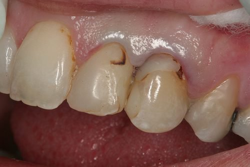 pochorn v zub p d plomboyu prichini l kuvannya vtorinnogo kar su 7 - Почорнів зуб під пломбою: причини, лікування вторинного карієсу