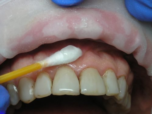 preparati dlya anestez v stomatolog pri l kuvann zub v 3 - Препарати для анестезії в стоматології при лікуванні зубів