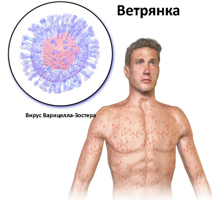 prof laktika v tryano v spi u doroslih ta d tey yak mozhna zarazitisya nkubac yniy per od zarazn st zahvoryuvannya 2 - Профілактика вітряної віспи у дорослих та дітей: як можна заразитися, інкубаційний період і заразність захворювання