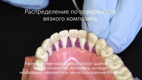 protezuvannya pri parodontit mplantac ya ortopedichn metodi l kuvannya 3 - Протезування при пародонтиті: імплантація, ортопедичні методи лікування