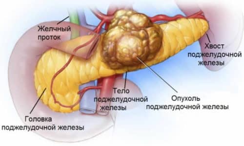 puhlina p dshlunkovo zalozi simptomi l kuvannya prognoz 2 - Пухлина підшлункової залози: симптоми, лікування, прогноз