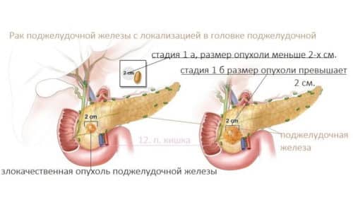 puhlina p dshlunkovo zalozi simptomi l kuvannya prognoz 3 - Пухлина підшлункової залози: симптоми, лікування, прогноз