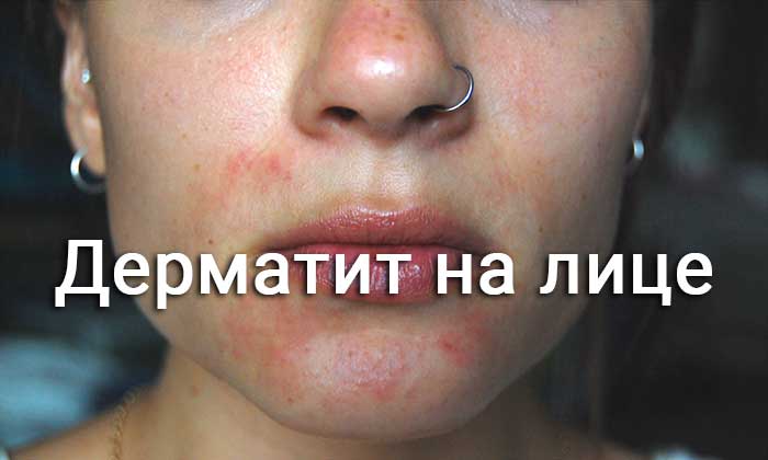 СЕБОЗОЛ – Інструкція із застосування, ціна, відгуки і аналоги sebozol nstrukc ya z zastosuvannya c na v dguki analogi 8 - СЕБОЗОЛ – Інструкція із застосування, ціна, відгуки і аналоги
