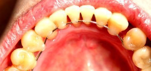 shinuvannya zub v pri parodontit vidi shin dlya l kuvannya 4 - Шинування зубів при пародонтиті: види шин для лікування