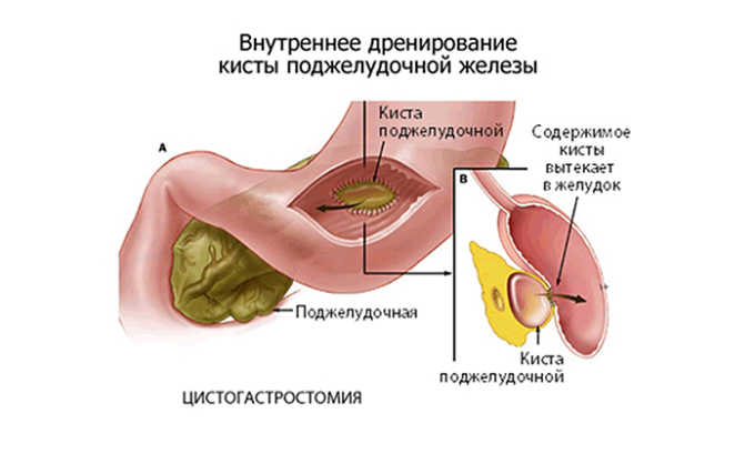 Симптоми панкреатиту у чоловіків: лікування, де болить, при алкоголізмі, при гострому і хронічному simptomi pankreatitu u cholov k v l kuvannya de bolit pri alkogol zm pri gostromu hron chnomu 5 - Симптоми панкреатиту у чоловіків: лікування, де болить, при алкоголізмі, при гострому і хронічному