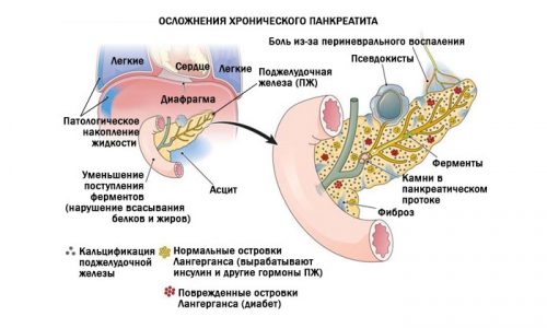 Симптоми панкреатиту у чоловіків: лікування, де болить, при алкоголізмі, при гострому і хронічному simptomi pankreatitu u cholov k v l kuvannya de bolit pri alkogol zm pri gostromu hron chnomu 6 - Симптоми панкреатиту у чоловіків: лікування, де болить, при алкоголізмі, при гострому і хронічному