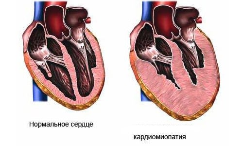 simptomi prichini l kuvannya alkogol no kard om opat 1 - Симптоми, причини і лікування алкогольної кардіоміопатії