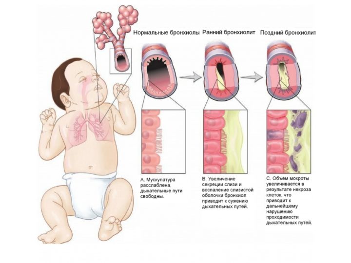simptomi ta d agnostika bronh t v obstruktivnogo gostrogo ta nshih vid v u d tey r znogo v ku 3 - Симптоми та діагностика бронхітів (обструктивного, гострого та інших видів) у дітей різного віку