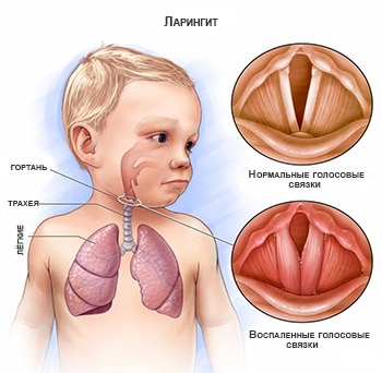 simptomi ta oznaki laring tu u novonarodzhenih nemovlyat d tey starshogo v ku v zalezhnost v d formi stad rozvitku zahvoryuvannya 2 - Симптоми та ознаки ларингіту у новонароджених, немовлят і дітей старшого віку в залежності від форми і стадії розвитку захворювання