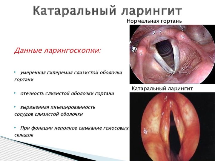 simptomi ta oznaki laring tu u novonarodzhenih nemovlyat d tey starshogo v ku v zalezhnost v d formi stad rozvitku zahvoryuvannya 5 - Симптоми та ознаки ларингіту у новонароджених, немовлят і дітей старшого віку в залежності від форми і стадії розвитку захворювання