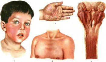 skarlatina u d tey simptomi l kuvannya 2 - Скарлатина у дітей: симптоми, лікування.