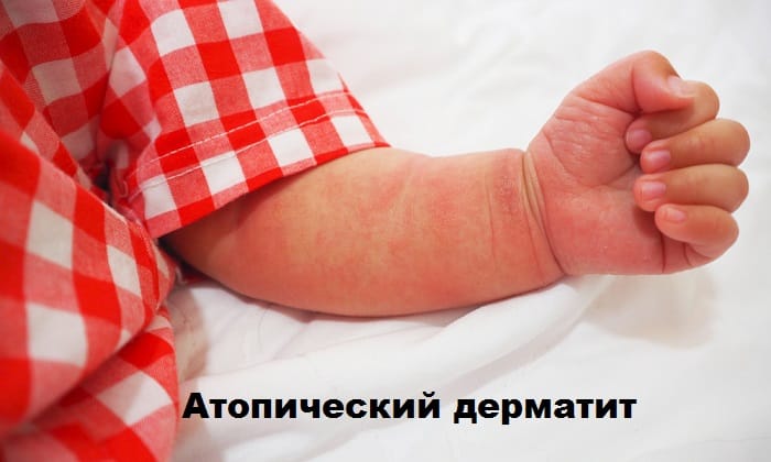 СПРЕЙ СКІН-КАП – інструкція із застосування, ціна, відгуки і аналоги sprey sk n kap nstrukc ya z zastosuvannya c na v dguki analogi 2 - СПРЕЙ СКІН-КАП – інструкція із застосування, ціна, відгуки і аналоги