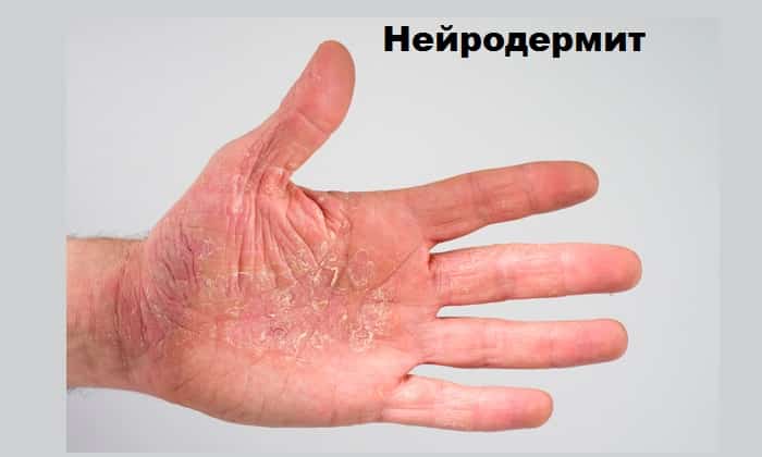 СПРЕЙ СКІН-КАП – інструкція із застосування, ціна, відгуки і аналоги sprey sk n kap nstrukc ya z zastosuvannya c na v dguki analogi 5 - СПРЕЙ СКІН-КАП – інструкція із застосування, ціна, відгуки і аналоги