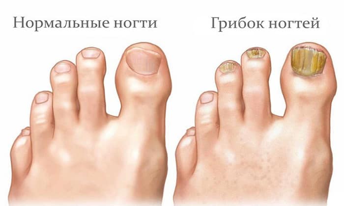 СПРЕЙ ТЕРМИКОН – інструкція із застосування, ціна, відгуки і аналоги sprey termikon nstrukc ya z zastosuvannya c na v dguki analogi 3 - СПРЕЙ ТЕРМИКОН – інструкція із застосування, ціна, відгуки і аналоги
