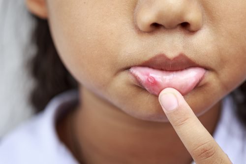 stomatit na gub u ditini l kuvannya n zh mazati 3 - Стоматит на губі у дитини: лікування, ніж мазати