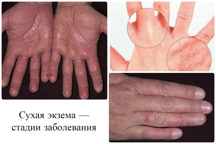 suha ekzema na rukah prichini simptomi l kuvannya narodnimi zasobami tradic ynoyu medicinoyu v deo 2 - Суха екзема на руках: причини, симптоми, лікування народними засобами і традиційною медициною, відео