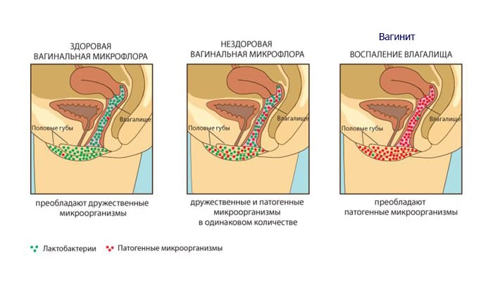 СВІЧКИ КАНЕСТЕН – інструкція із застосування, ціна, відгуки і аналоги sv chki kanesten nstrukc ya z zastosuvannya c na v dguki analogi 4 - СВІЧКИ КАНЕСТЕН – інструкція із застосування, ціна, відгуки і аналоги