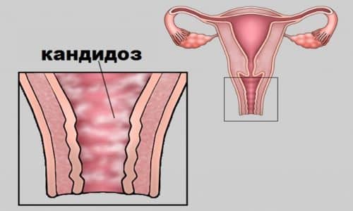 sv chki ketokonazol nstrukc ya z zastosuvannya c na v dguki analogi 2 - СВІЧКИ КЕТОКОНАЗОЛ – інструкція із застосування, ціна, відгуки і аналоги