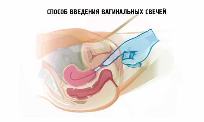 СВІЧКИ МЕТРОНІДАЗОЛ – інструкція із застосування, ціна, відгуки і аналоги sv chki metron dazol nstrukc ya z zastosuvannya c na v dguki analogi 11 - СВІЧКИ МЕТРОНІДАЗОЛ – інструкція із застосування, ціна, відгуки і аналоги