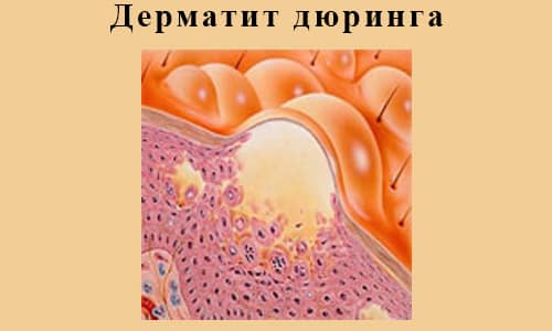 Свічки Повідон-йод: інструкція по застосуванню sv chki pov don yod nstrukc ya po zastosuvannyu 7 - Свічки Повідон-йод: інструкція по застосуванню