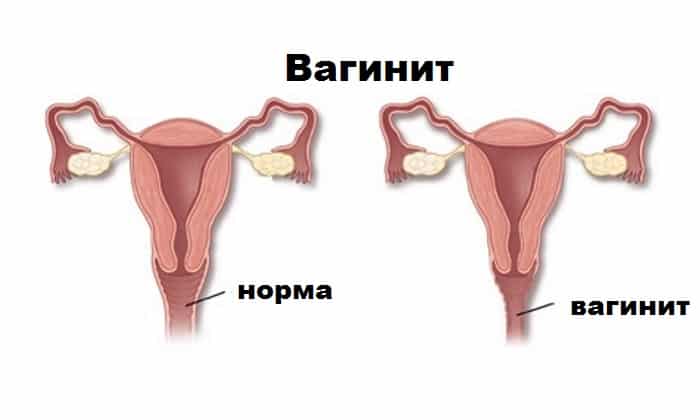 СВІЧКИ ПОВІДОН ЙОД – інструкція із застосування, ціна, відгуки і аналоги sv chki pov don yod nstrukc ya z zastosuvannya c na v dguki analogi 1 - СВІЧКИ ПОВІДОН ЙОД – інструкція із застосування, ціна, відгуки і аналоги