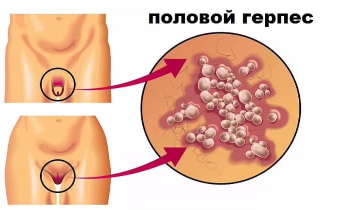 СВІЧКИ ПОВІДОН ЙОД – інструкція із застосування, ціна, відгуки і аналоги sv chki pov don yod nstrukc ya z zastosuvannya c na v dguki analogi 2 - СВІЧКИ ПОВІДОН ЙОД – інструкція із застосування, ціна, відгуки і аналоги