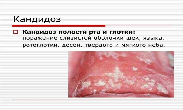 tabletki flukonazol nstrukc ya z zastosuvannya c na v dguki analogi 1 - ТАБЛЕТКИ ФЛУКОНАЗОЛ – інструкція із застосування, ціна, відгуки і аналоги