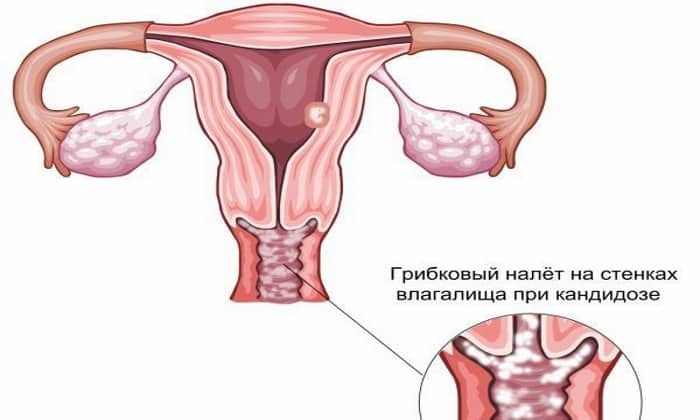 tabletki flukonazol nstrukc ya z zastosuvannya c na v dguki analogi 2 - ТАБЛЕТКИ ФЛУКОНАЗОЛ – інструкція із застосування, ціна, відгуки і аналоги