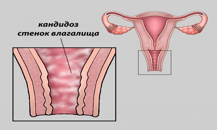 ТАБЛЕТКИ КЛОТРИМАЗОЛ – інструкція із застосування, ціна, відгуки і аналоги tabletki klotrimazol nstrukc ya z zastosuvannya c na v dguki analogi 3 - ТАБЛЕТКИ КЛОТРИМАЗОЛ – інструкція із застосування, ціна, відгуки і аналоги