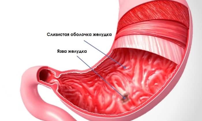 ТАБЛЕТКИ МЕТРОГІЛ – інструкція із застосування, ціна, відгуки і аналоги tabletki metrog l nstrukc ya z zastosuvannya c na v dguki analogi 4 - ТАБЛЕТКИ МЕТРОГІЛ – інструкція із застосування, ціна, відгуки і аналоги