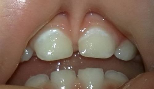 temn plyami na zubah u ditini prichini mozhliv zahvoryuvannya 8 - Темні плями на зубах у дитини: причини, можливі захворювання