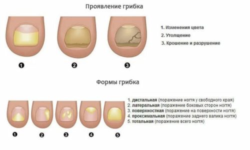 terb naf n kanon nstrukc ya z zastosuvannya c na v dguki analogi 12 - ТЕРБІНАФІН КАНОН – інструкція із застосування, ціна, відгуки і аналоги